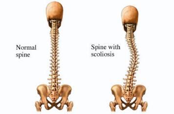 What is Schroth Therapy for Scoliosis? - Westside Children's Therapy