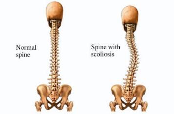 photo of a scoliosis spine for the blog at westside children's therapy's website introducing schroth therapy