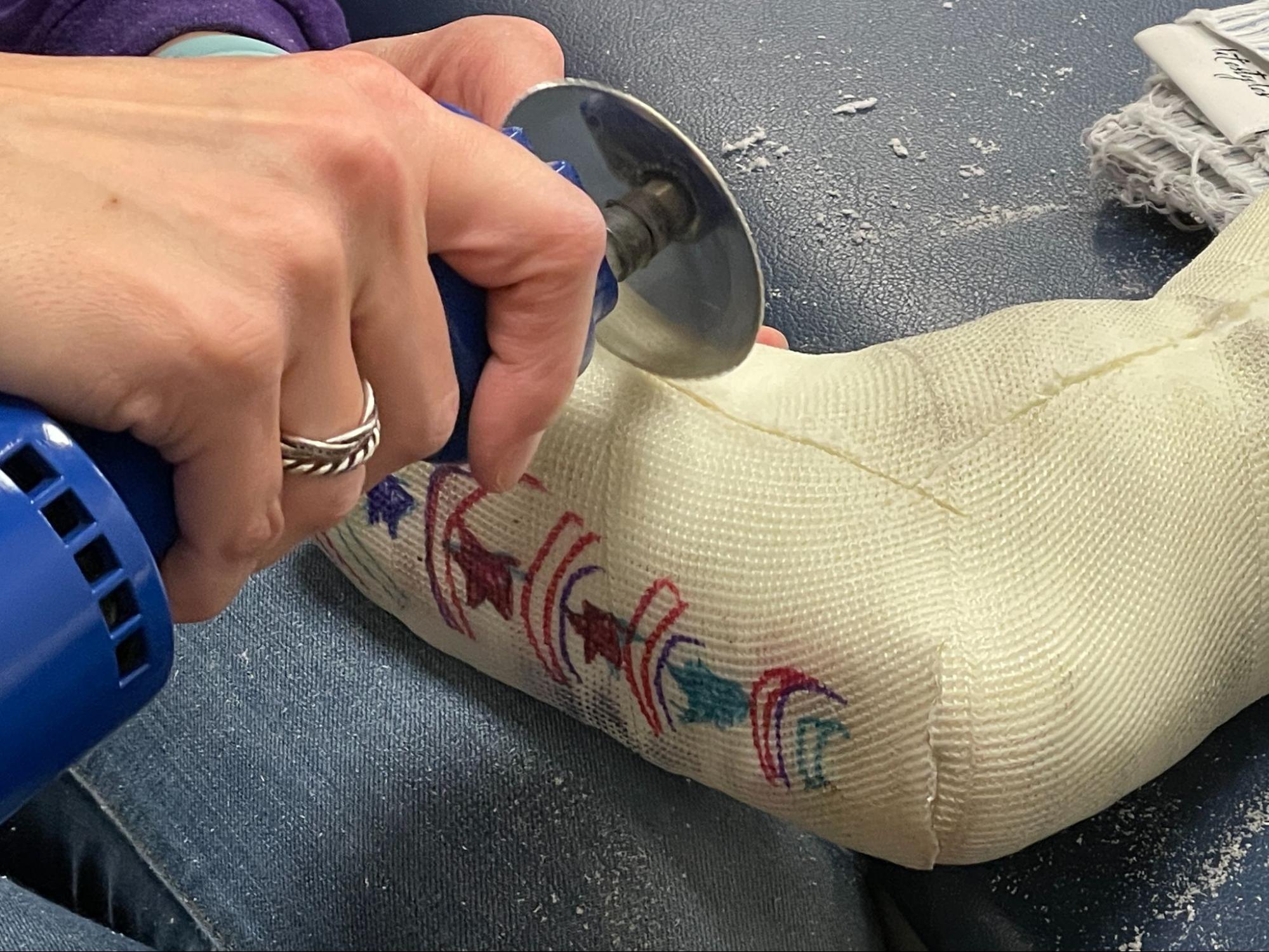 photo of a serial casting being removed from a child's leg after the final session.  Taken at Westside Children's Therapy in Illinois