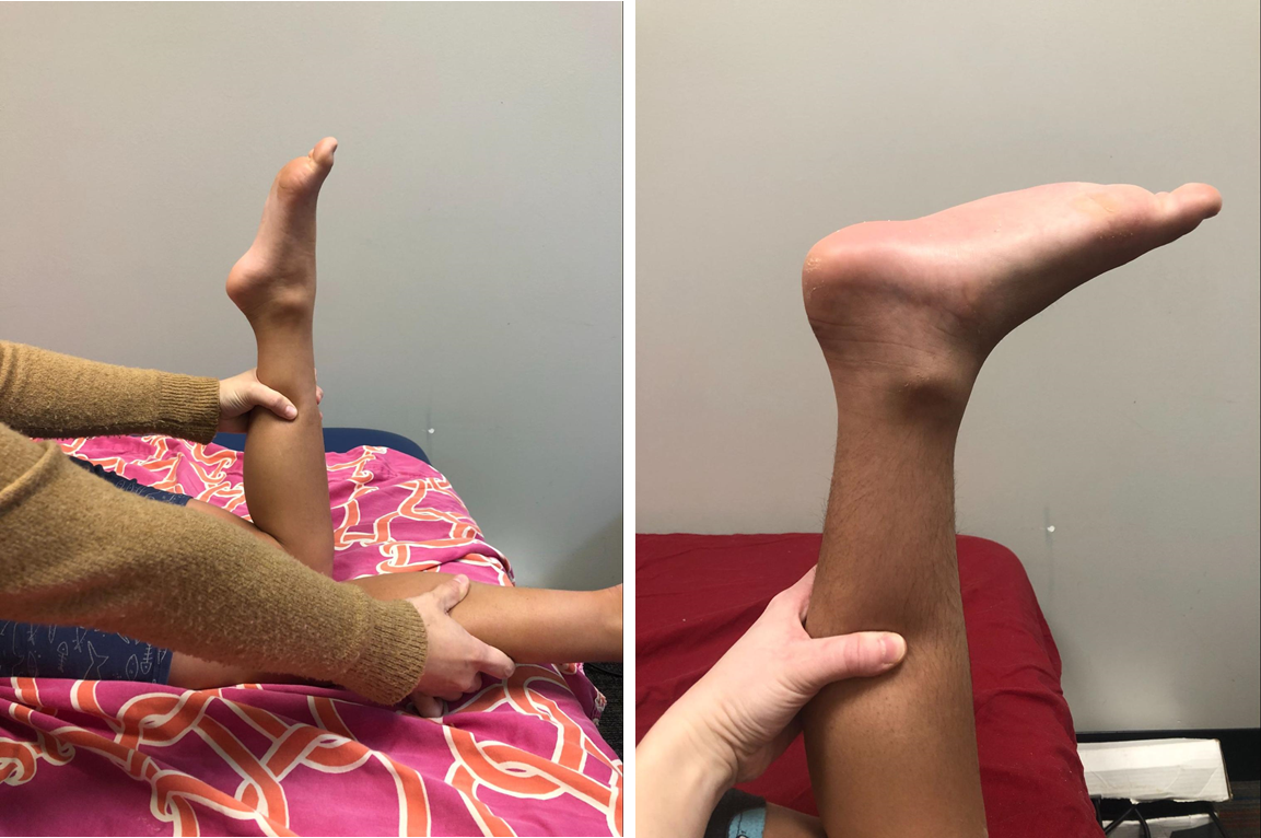 results picture of a toe walker child before and after a serial casting, taken at Westside Children's Therapy in Illinois