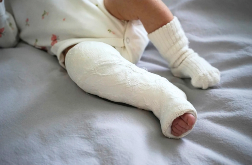 A baby's leg in a white plaster serial cast up to the knee, lying on a bed next to their other sock-covered foot.