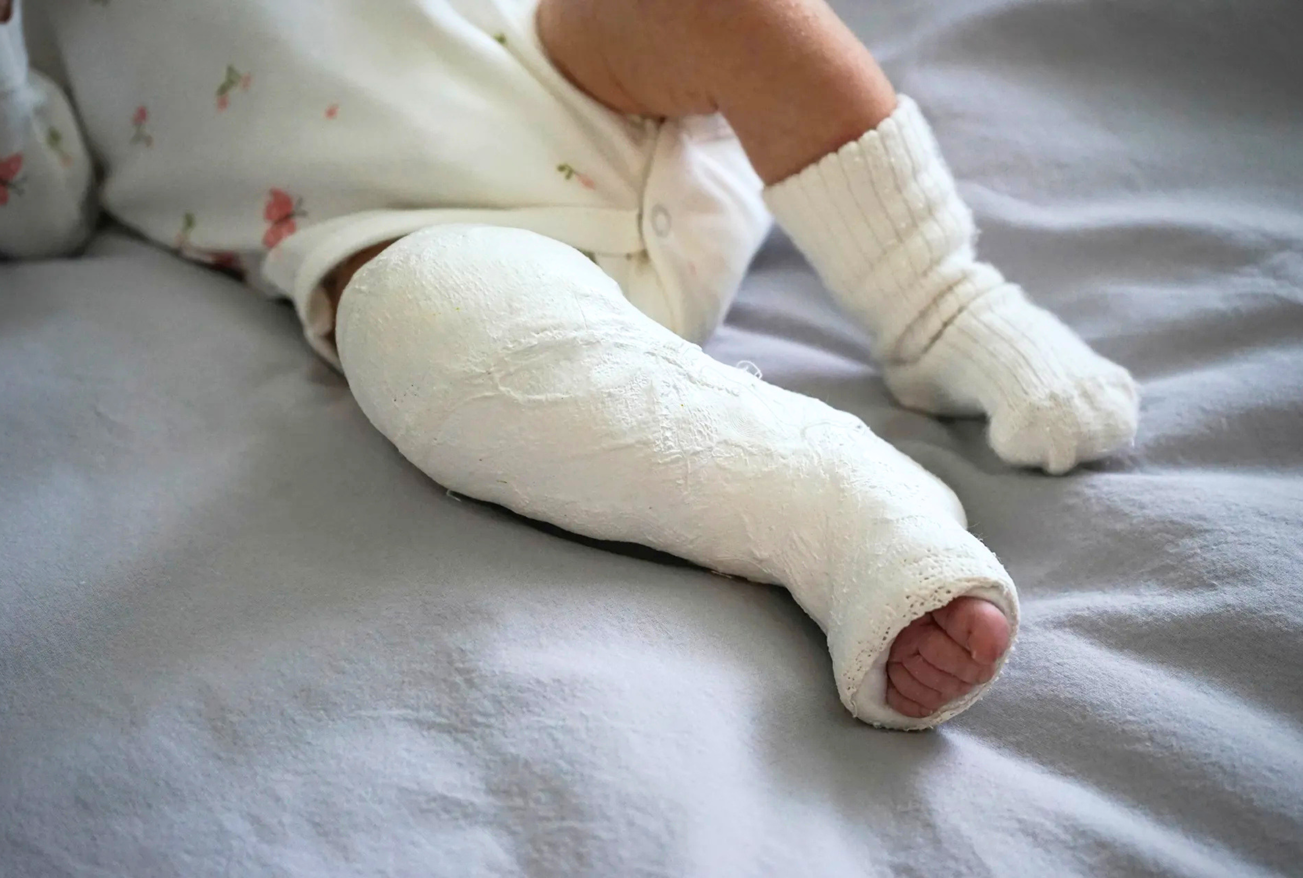 A baby's leg in a white plaster serial cast up to the knee, lying on a bed next to their other sock-covered foot.