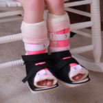 A child sits on a white rocking chair wearing pink serial casts on both lower legs with black cast shoes, representing what changes before and after serial casting for toe walking.