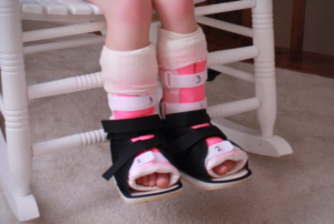 A child sits on a white rocking chair wearing pink serial casts on both lower legs with black cast shoes, representing what changes before and after serial casting for toe walking.
