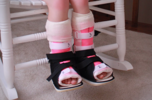 A child sits on a white rocking chair wearing pink serial casts on both lower legs with black cast shoes, representing what changes before and after serial casting for toe walking.